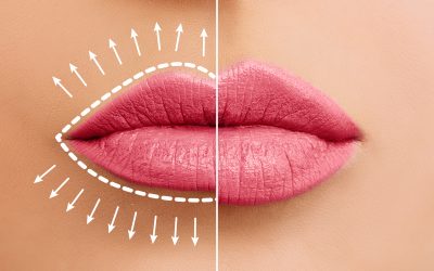 Lippenunterspritzung: Wie lange hält das Ergebnis an?